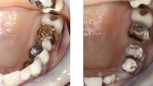 Amalgamfüllung Risiken D-Tox Dental