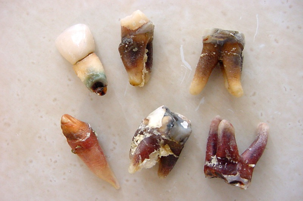In diesem Zustand sind wurzelbehandelte Zähne nach ihrer Entfernung aufgrund von diversen Schmerzsymptomen
