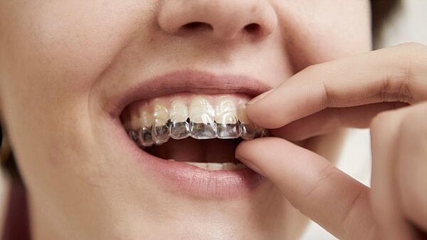 Mit nahezu unsichtbaren Kunststoffschienen, sogenannten Aligner Zahnschienen, bewegen wir Ihre Zähne sanft, aber mit Nachdruck in die richtige Position.