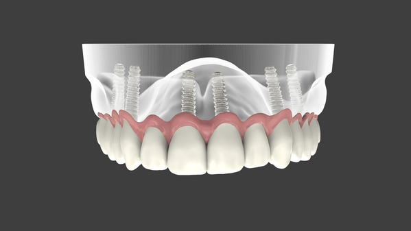 Keramikimplantate