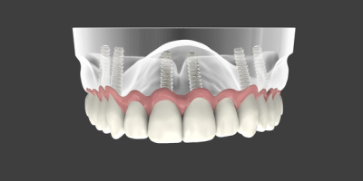 Keramikimplantate